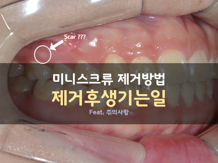 교정용 미니스크류(SAS, TAD, miniscrew) 제거 방법/미니스크류 제거 후 상처/ 미니스크류 제거 후 주의사항 교정용 미니스크류(SAS, TAD, miniscrew) 제거 방법/미니스크류 제거 후 상처/ 미니스크류 제거 후 주의사항