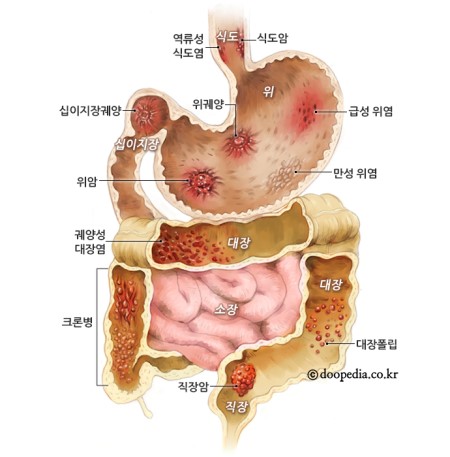 역류성 식도염에 좋은 음식과 나쁜 음식