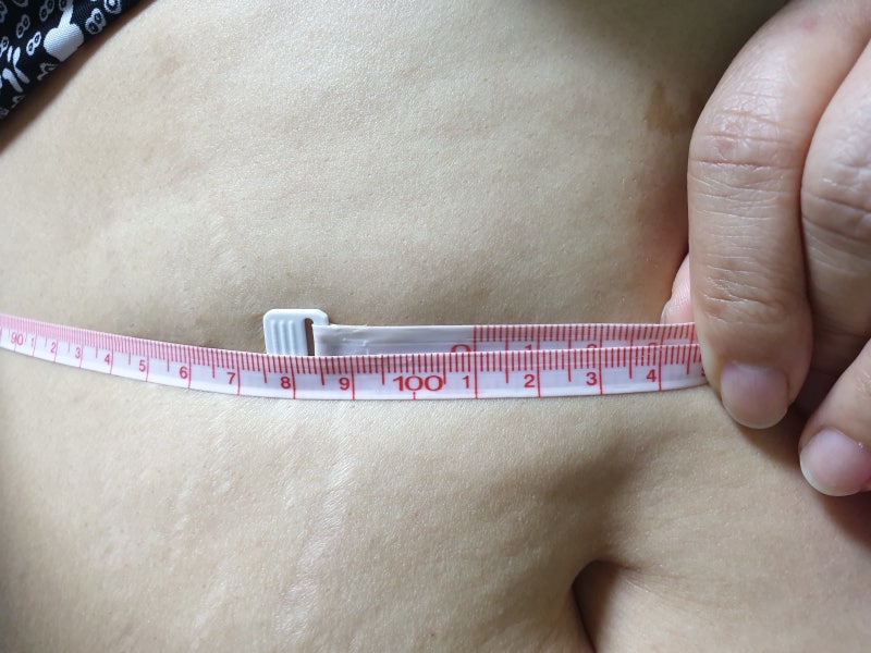 2.5kg감량 후 복부지방용융주사 효과 4