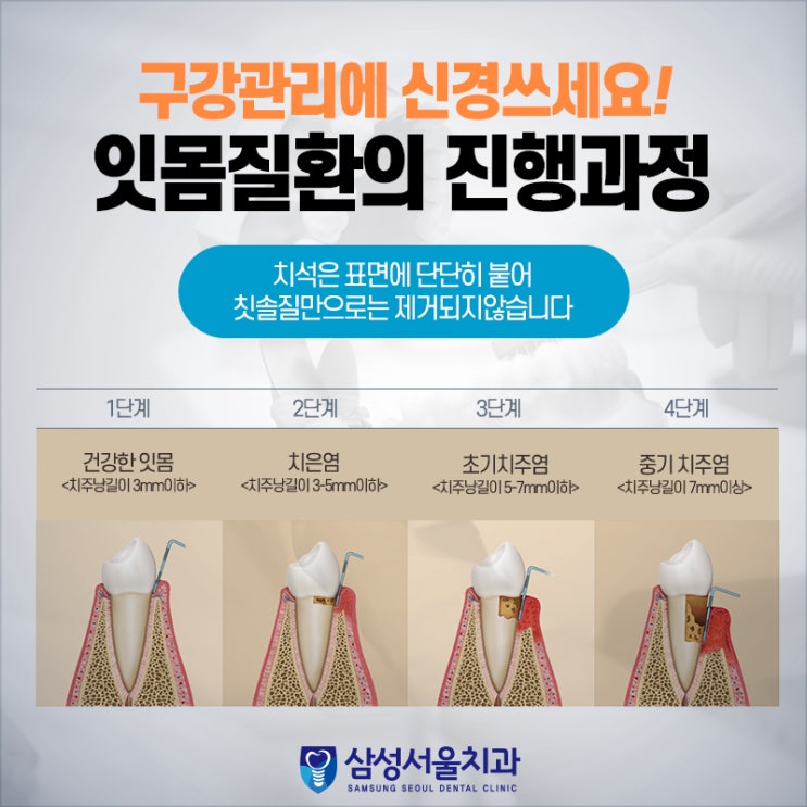  잇몸치료 6개월 경과 관찰하기, 원주 무실동 삼성서울치과에서 잇몸치료 하기
