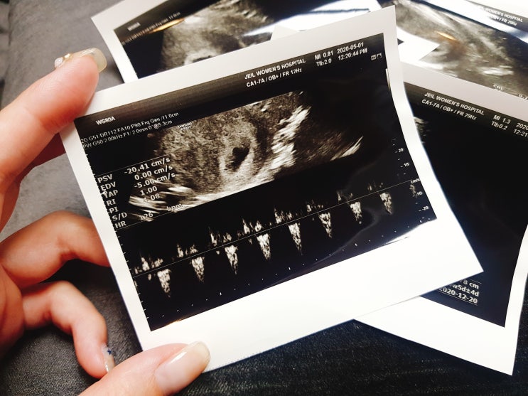 임신일기③ [임신 6주차 증상] 초음파 심장소리 확인+산전검사+부모님께 알리기