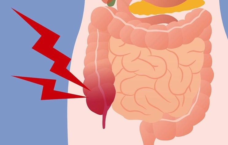 Appendectomy 충수돌기절제술 간호사가 쉽게 정리