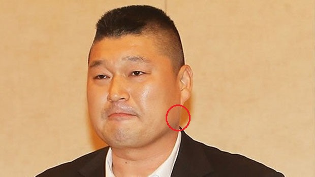 침샘 보톡스, 왜 맞는 것이고 어떤 효과가 있는가?
