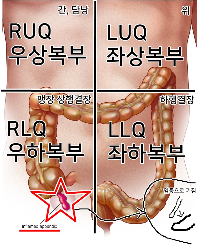  충수돌기염 appendicitis 빠른 진단 위해 병원가세요