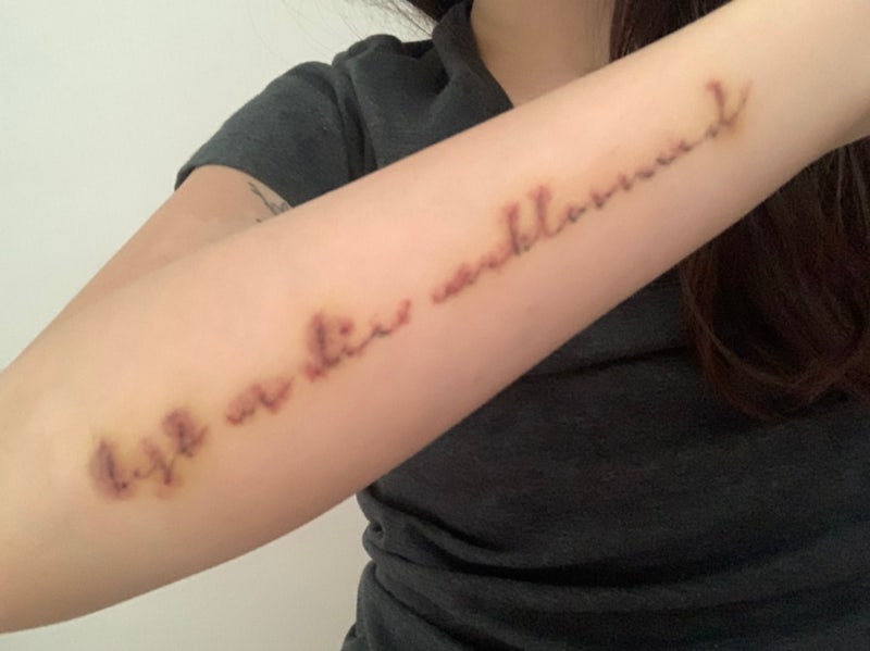 레터링 타투 손목타투제거 2차 리뷰 (부작용있음) 레터링 타투 손목타투제거 2차 리뷰 (부작용있음)