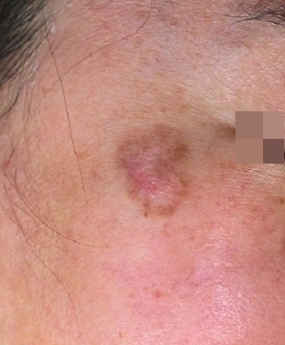 오래된 심재성 2도, 3도 화상 흉터 치료, 색소 침착 레이저 치료 사진 : 강서구 화곡 리뉴미 피부과 3