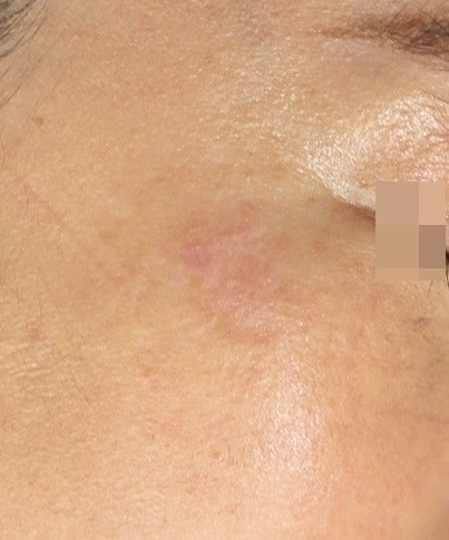 오래된 심재성 2도, 3도 화상 흉터 치료, 색소 침착 레이저 치료 사진 : 강서구 화곡 리뉴미 피부과 6