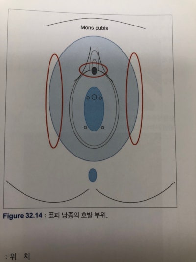 Q33.피지낭종(표피낭종)과 지방종의 차이점, 원인,위치,치료,형태 (참고:부인과 피부과학) 피부질환 /피부 낭종 알아보기 ...