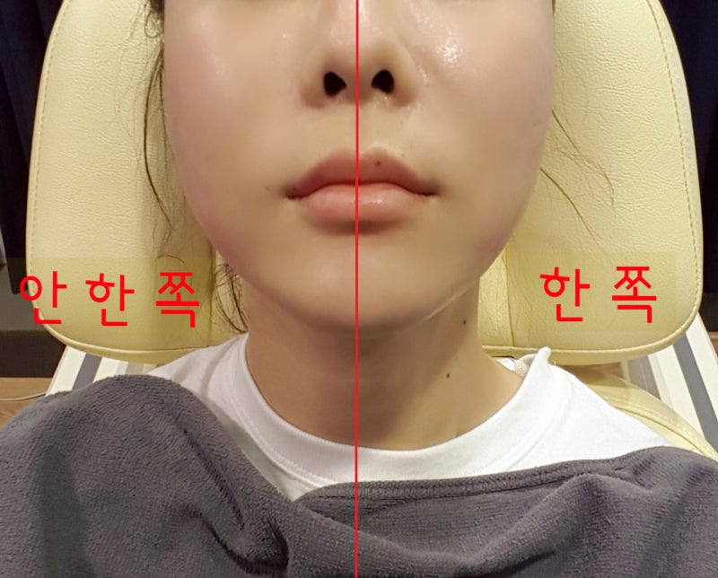 [ 신사동피부과 ] 안아픈 올리지오 6