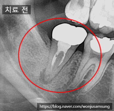  오른쪽어금니 치통, 재신경치료 및 크라운 진행하기, 원주 무실동 삼성서울치과에서 신경치료 하기