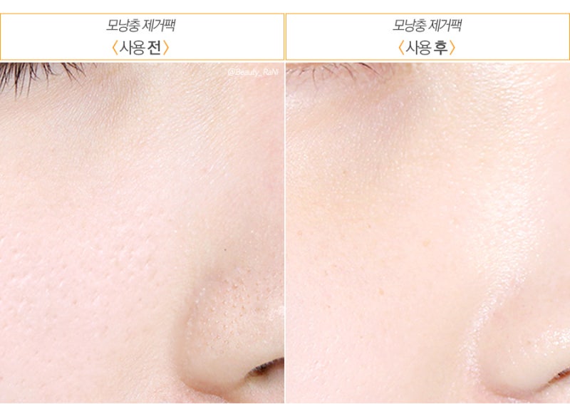 모낭충제거집중케어개선팁