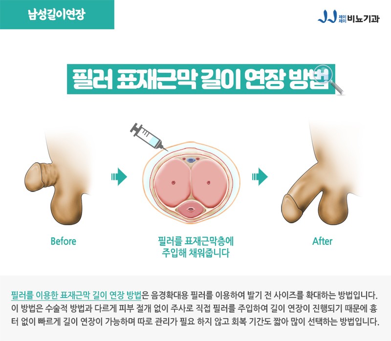 남성길이연장 병원 선택을 신중하게 : 네이버 블로그