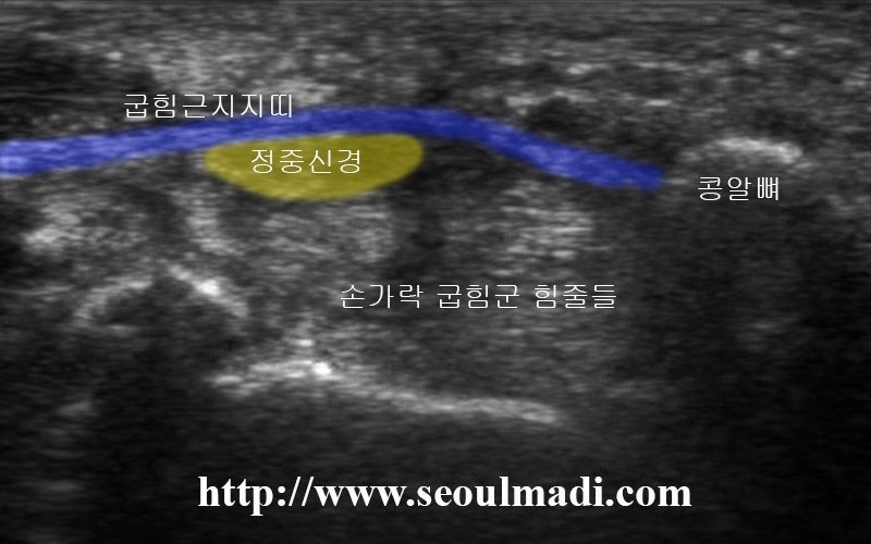 손목터널증후군의 원인과 증상, 주의사항, 검사, 치료방법을 알아봅시다.
