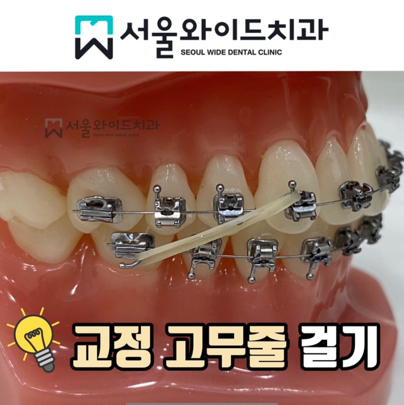 치아교정 고무줄 언제할까? 착용 기간, 통증, 주의사항, 거는 방법에 대해 : 네이버 블로그 치아교정 고무줄 언제할까? 착용 기간, 통증, 주의사항, 거는 방법에 대해 : 네이버 블로그