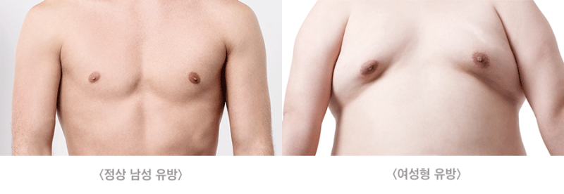 남자인데 가슴이 봉긋? 여유증 자가진단 테스트 : 네이버 블로그 남자인데 가슴이 봉긋? 여유증 자가진단 테스트 : 네이버 블로그