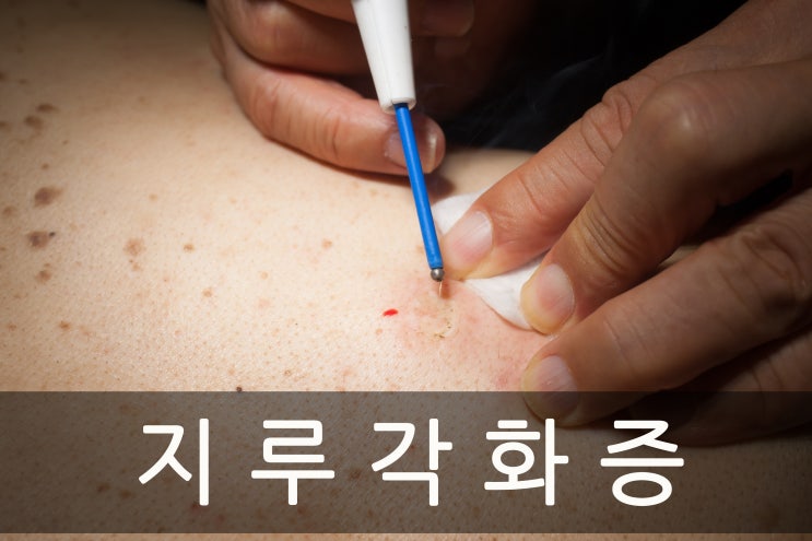  지루각화증 전기수술로 제거