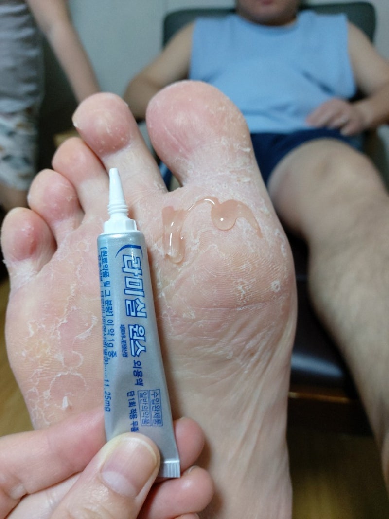 라미실원스 내돈내산 리얼후기 (혐오사진 주의) 무좀치료후기 : 네이버 블로그 라미실원스 내돈내산 리얼후기 (혐오사진 주의) 무좀치료후기 : 네이버 블로그