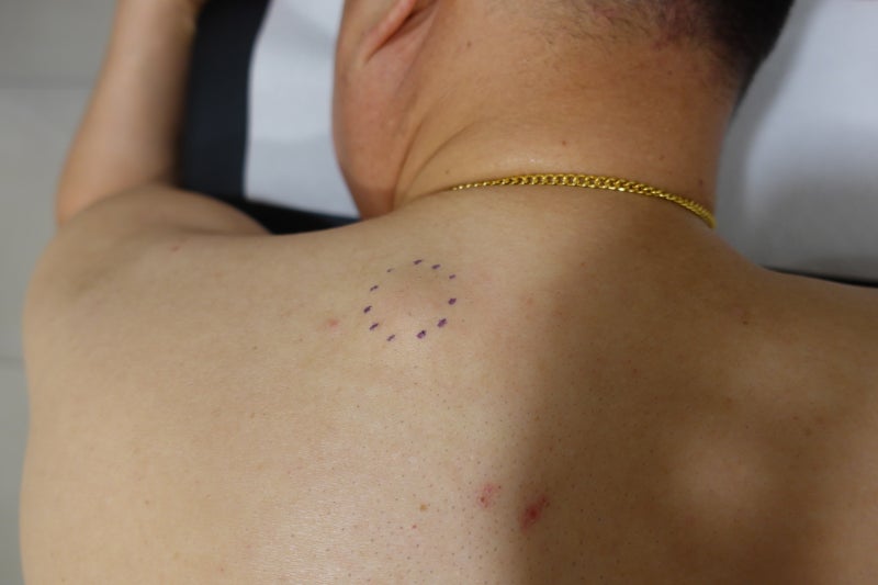 [Dr.ParK] 등 깊숙한 곳에서 혹이 만져집니다. 근막에 둘러싸인 지방종 제거 수술 3