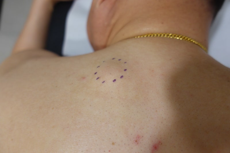 [Dr.ParK] 등 깊숙한 곳에서 혹이 만져집니다. 근막에 둘러싸인 지방종 제거 수술 6