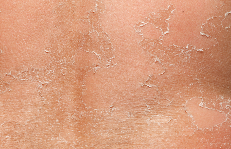 박피와 필링이 피부 건강에 미치는