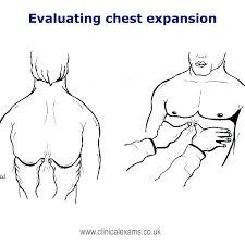 [PK생활] 류마티스내과. 강직척추염 Ankylosing spondylitis. (shober test, chest ...