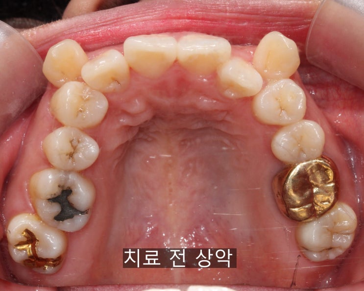  교정 시행 전 전체 충치 치료 및 보철치료 , 원주 무실동 삼성서울치과에서 충치치료