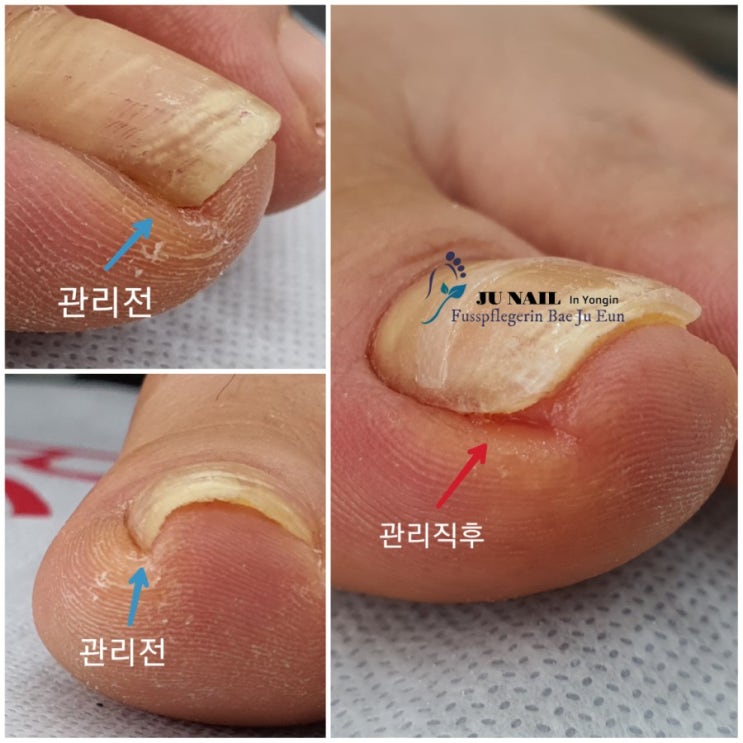 엄지발톱 누르면 아파요. /분당용인수원수지보정동백죽전동/주네일/무좀파고드는내향성발톱손톱변형전문네일샵