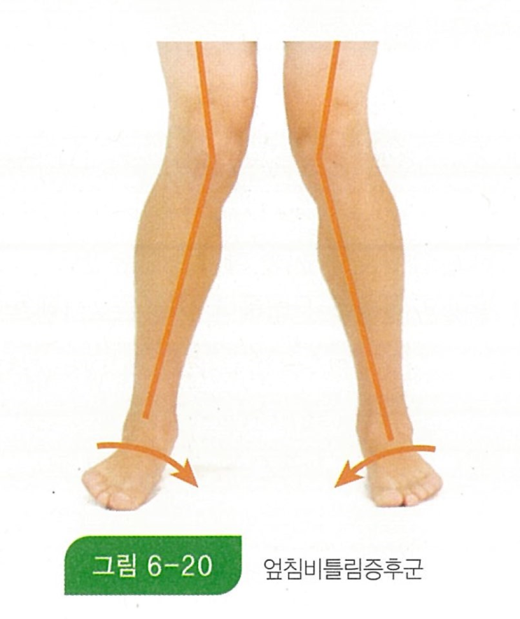  NASM-CPT 상지교차증후군, 하지교차증후군, 엎침비틀림증후군