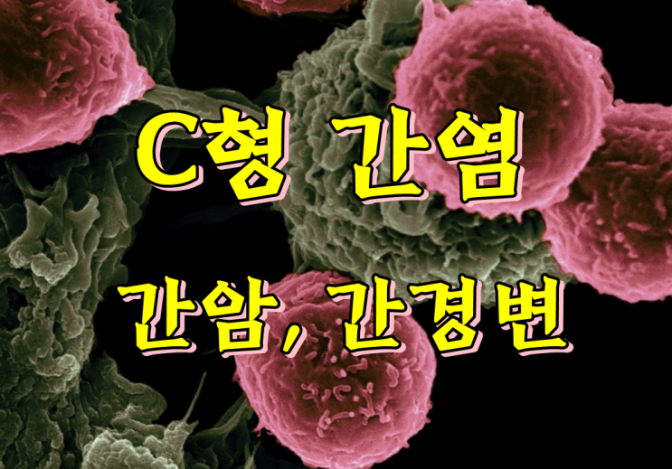  예방접종 불가! C형간염 증상 조심하세요.