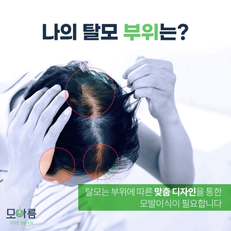 강남역연예인모발이식 탈모가 고민이시라면 비절개 모발이식 소개합니다