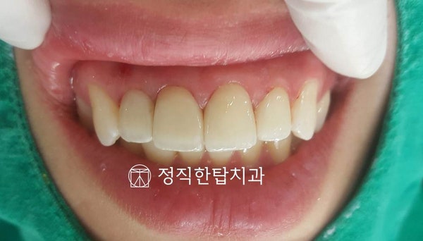 양전자 지르코니아 6