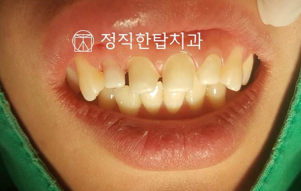 양전자 지르코니아 7