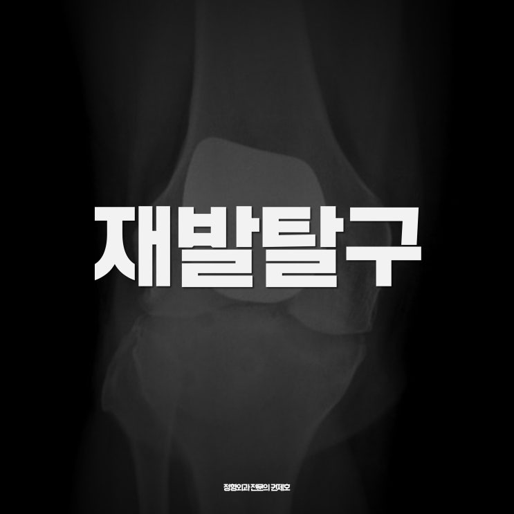  재발하는 슬개골 탈구는 원위 대퇴 절골술 by 권제호무릎수술일지