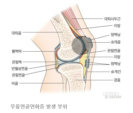 구로디지털단지 무릎수술 체중조절이 필요한 이유 2