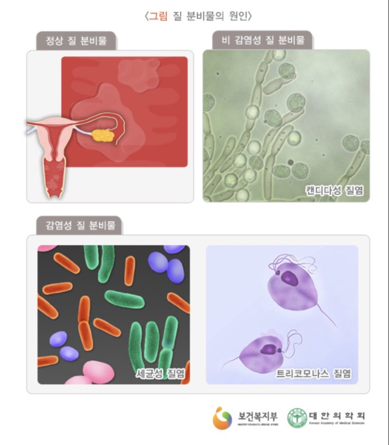 Gardnerella에 의한 것으로 의심되는 악취 분비물! 6