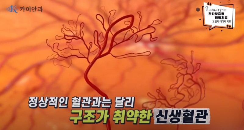 망막 레이저 방법과 효과_선릉역 안과 : 네이버 블로그