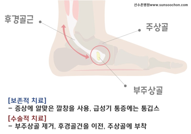 부주상골 증후군 증상 및 깔창 및 3