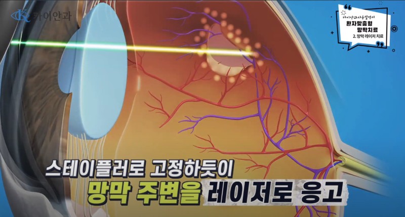 망막 레이저 방법과 효과_선릉역 안과 : 네이버 블로그