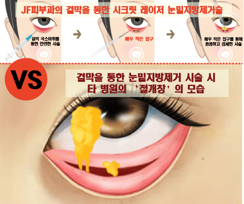 눈밑 지방보정 - JF의 타 병원과의 차별성!