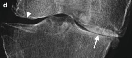  [KMLE] 골관절염 OA(osteoarthritis), 통풍 gout, 가성통풍(pseudo-gout) 구분, 정리 및 치료 (Allopurinol, probenecid..)