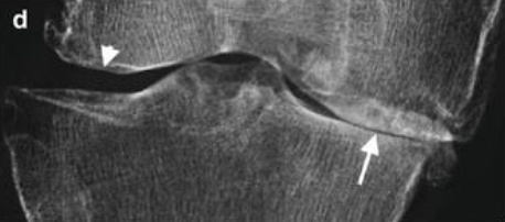 [KMLE] 골관절염 OA(osteoarthritis), 통풍 gout, 가성통풍(pseudo-gout) 구분, 정리 및 치료 (Allopurinol, probenecid..)