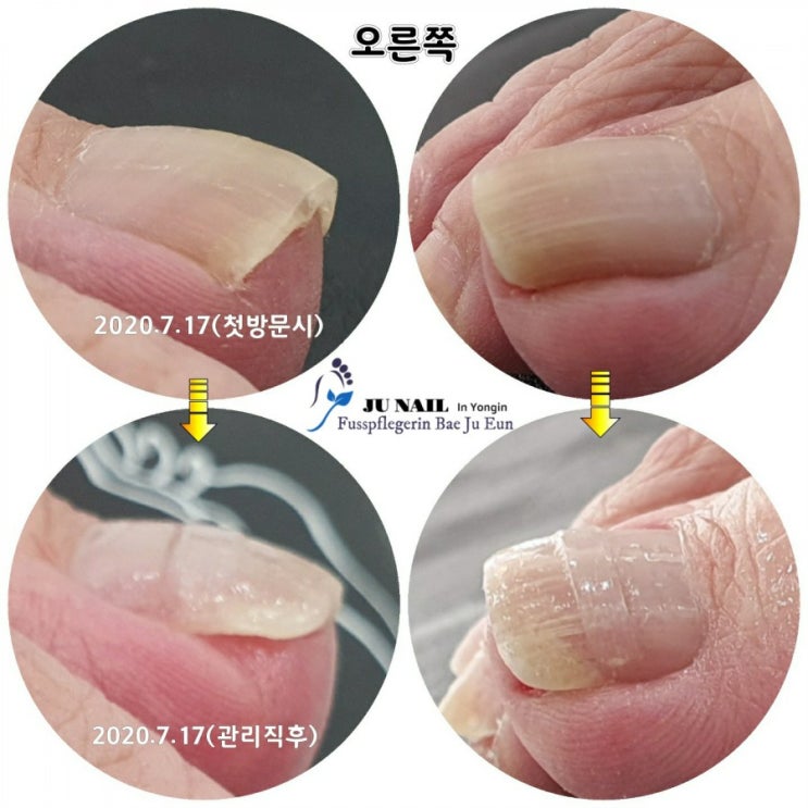 살을파고드는 내향성발톱관리 어떻게하세요?/분당용인수원수지보정동백죽전동/주네일/무좀파고드는내향성발톱손톱변형전문네일샵