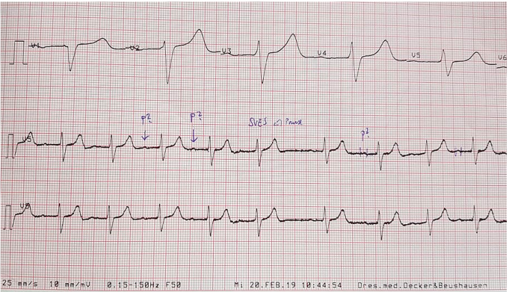 [KMLE] 심전도 EKG 판독 하는 순서 (Rhythm, Rate, P wave, PR interval, PR segment, QRS complex, T wave)