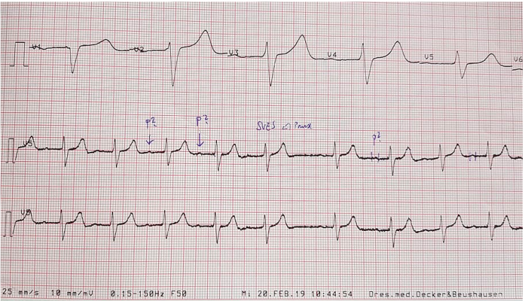  [KMLE] 심전도 EKG 판독 하는 순서 (Rhythm, Rate, P wave, PR interval, PR segment, QRS complex, T wave)