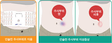  당뇨병 인슐린 종류 투여방법 주의사항 2편 : 정상혈당 저혈당 인슐린혼합 보관방법