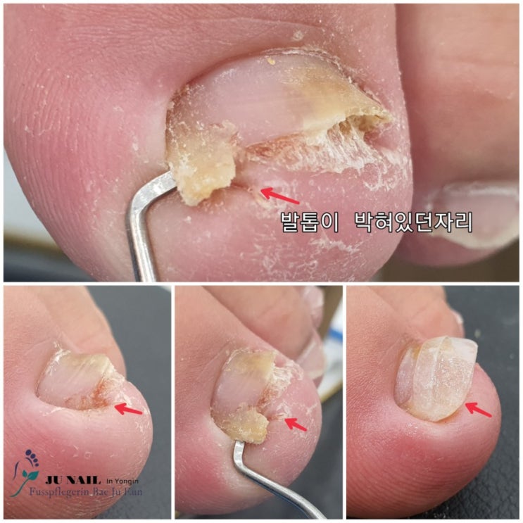 발톱이 살을 파고들때 계속 잘라내면 염증생겨요./분당용인수원수지보정동백죽전동/주네일/무좀파고드는내향성발톱손톱변형전문네일샵