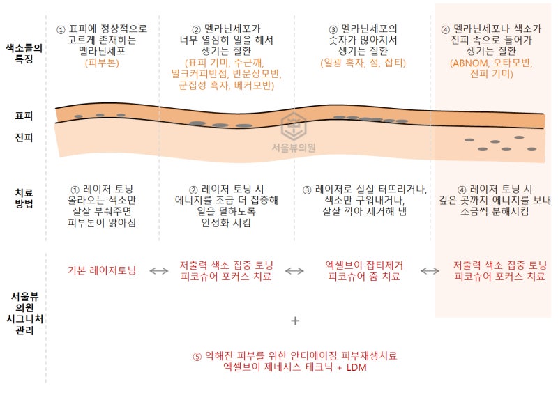 유성피부과, ABNOM(후천성오타양모반) 치료하기 : 네이버 블로그