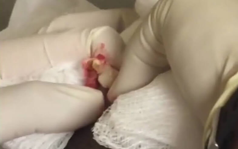 고환 피지 낭종 제거비용은? : 네이버 블로그 고환 피지 낭종 제거비용은? : 네이버 블로그