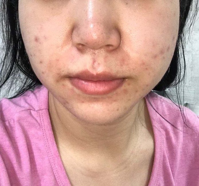  모낭염한의원 리유 박해웅원장님께 한달동안 치료 받은 후 상태