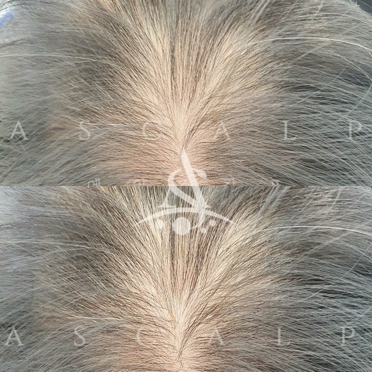  울산탈모 남들과는 다르게